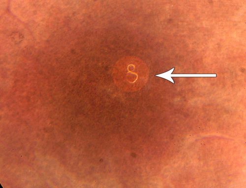 DUSN - Diffuse Unilateral Subacute Neuroretinitis - Nematode
