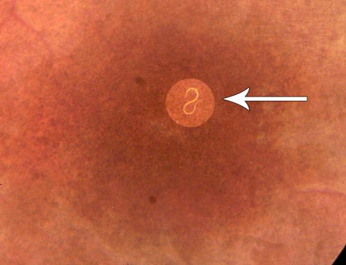 DUSN - Diffuse Unilateral Subacute Neuroretinitis - Nematode
