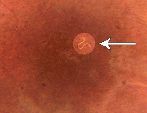 DUSN - Diffuse Unilateral Subacute Neuroretinitis - Nematode
