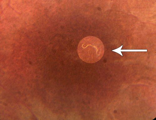DUSN - Diffuse Unilateral Subacute Neuroretinitis - Nematode
