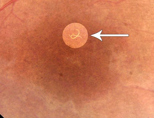 DUSN - Diffuse Unilateral Subacute Neuroretinitis - Nematode
