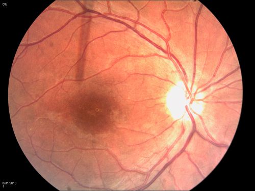 DUSN - Diffuse Unilateral Subacute Neuroretinitis - Nematode
