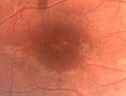DUSN - Diffuse Unilateral Subacute Neuroretinitis - Nematode
