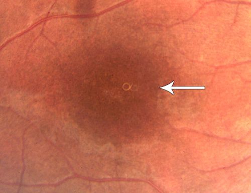 DUSN - Diffuse Unilateral Subacute Neuroretinitis - Nematode
