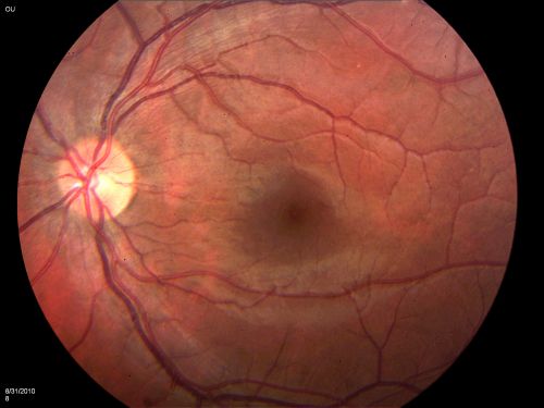 DUSN - Diffuse Unilateral Subacute Neuroretinitis - Nematode
