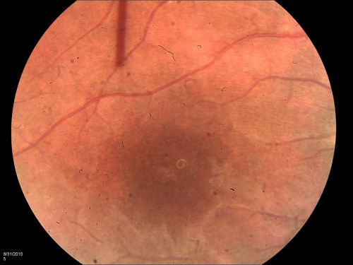 DUSN - Diffuse Unilateral Subacute Neuroretinitis - Nematode
