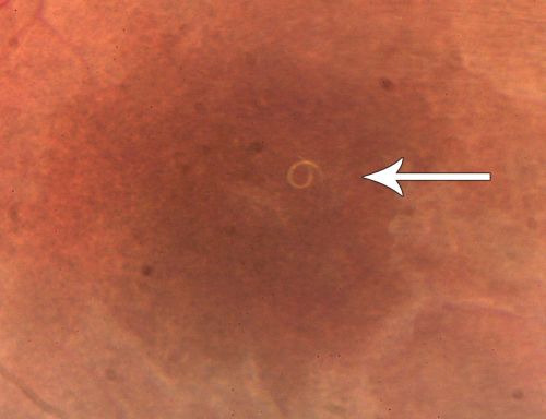 DUSN - Diffuse Unilateral Subacute Neuroretinitis - Nematode
