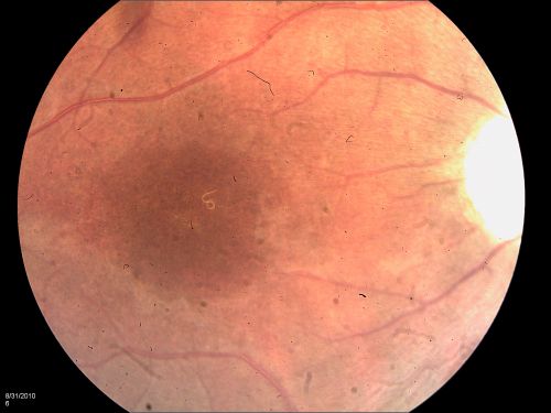 DUSN - Diffuse Unilateral Subacute Neuroretinitis - Nematode
