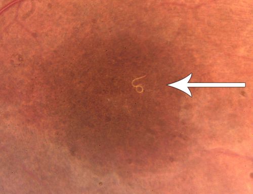 DUSN - Diffuse Unilateral Subacute Neuroretinitis - Nematode
