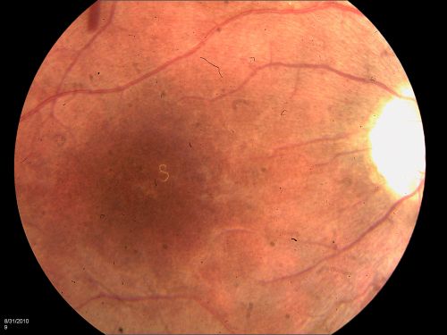 DUSN - Diffuse Unilateral Subacute Neuroretinitis - Nematode
