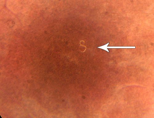 DUSN - Diffuse Unilateral Subacute Neuroretinitis - Nematode
