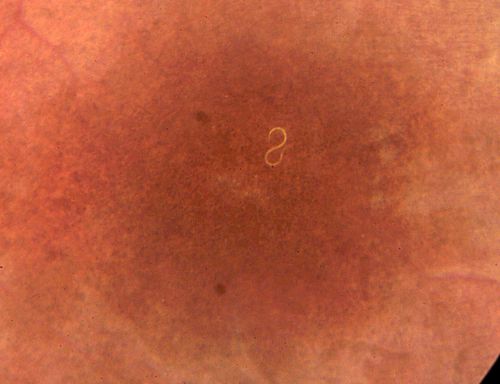 DUSN - Diffuse Unilateral Subacute Neuroretinitis - Nematode
