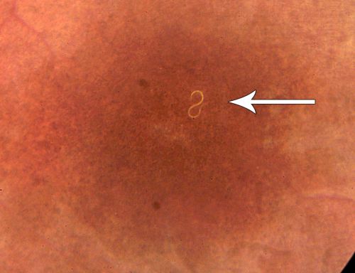 DUSN - Diffuse Unilateral Subacute Neuroretinitis - Nematode

