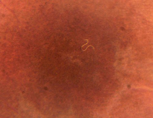 DUSN - Diffuse Unilateral Subacute Neuroretinitis - Nematode

