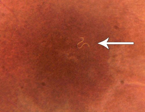 DUSN - Diffuse Unilateral Subacute Neuroretinitis - Nematode
