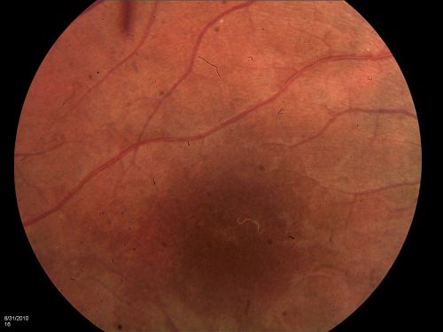 DUSN - Diffuse Unilateral Subacute Neuroretinitis - Nematode
