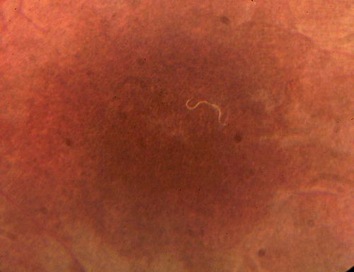 DUSN - Diffuse Unilateral Subacute Neuroretinitis - Nematode

