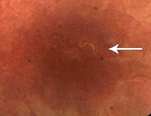 DUSN - Diffuse Unilateral Subacute Neuroretinitis - Nematode
