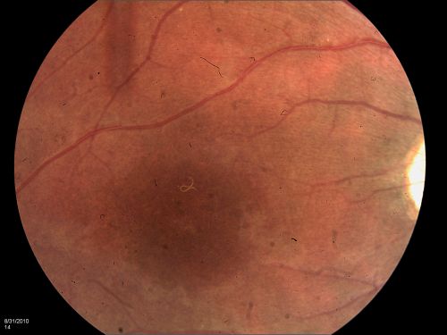 DUSN - Diffuse Unilateral Subacute Neuroretinitis - Nematode
