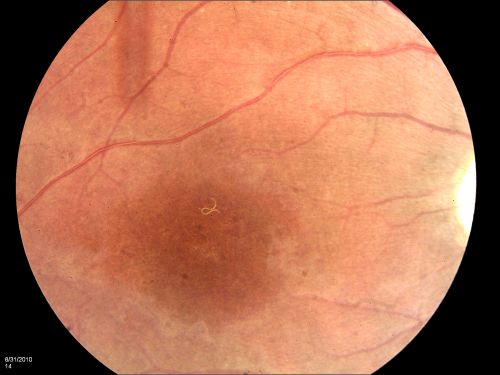 DUSN - Diffuse Unilateral Subacute Neuroretinitis - Nematode
