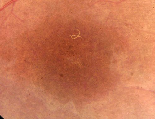 DUSN - Diffuse Unilateral Subacute Neuroretinitis - Nematode
