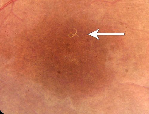 DUSN - Diffuse Unilateral Subacute Neuroretinitis - Nematode
