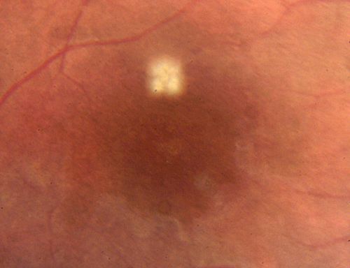 DUSN - Diffuse Unilateral Subacute Neuroretinitis - Nematode
