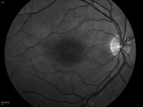 DUSN - Diffuse Unilateral Subacute Neuroretinitis - Nematode
