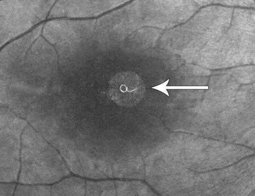 DUSN - Diffuse Unilateral Subacute Neuroretinitis - Nematode
