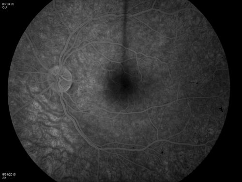DUSN - Diffuse Unilateral Subacute Neuroretinitis - Nematode
