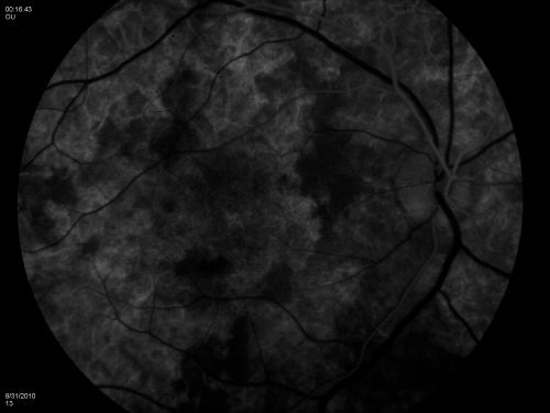 DUSN - Diffuse Unilateral Subacute Neuroretinitis - Nematode
