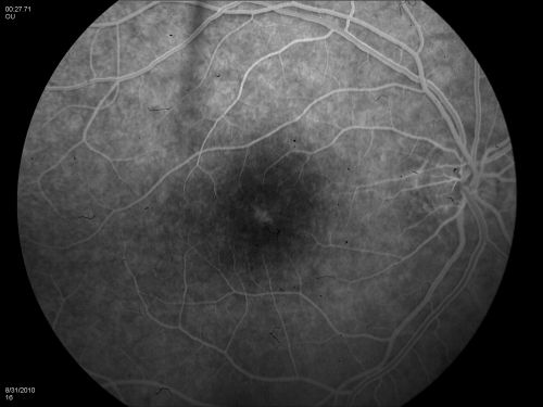 DUSN - Diffuse Unilateral Subacute Neuroretinitis - Nematode
