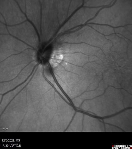 Macular schisis with no leakage on FA - Presumed Nerve pit maculopathy
73-year old female.  Had treatment trial with Eylea with no benefit (4 months).  Vision is 20/32 in left eye and has remained there (with a dense cataract).
