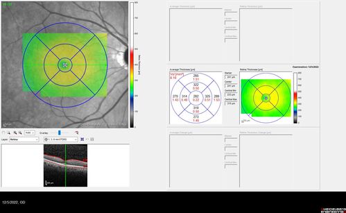 Macular schisis with no leakage on FA - Presumed Nerve pit maculopathy
73-year old female.  Had treatment trial with Eylea with no benefit (4 months).  Vision is 20/32 in left eye and has remained there (with a dense cataract).
