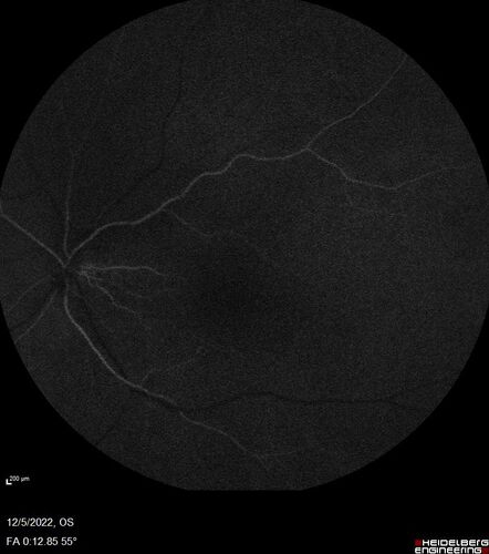 Macular schisis with no leakage on FA - Presumed Nerve pit maculopathy
73-year old female.  Had treatment trial with Eylea with no benefit (4 months).  Vision is 20/32 in left eye and has remained there (with a dense cataract).
