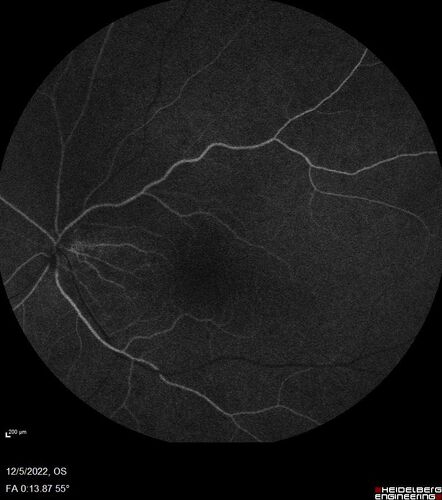 Macular schisis with no leakage on FA - Presumed Nerve pit maculopathy
73-year old female.  Had treatment trial with Eylea with no benefit (4 months).  Vision is 20/32 in left eye and has remained there (with a dense cataract).
