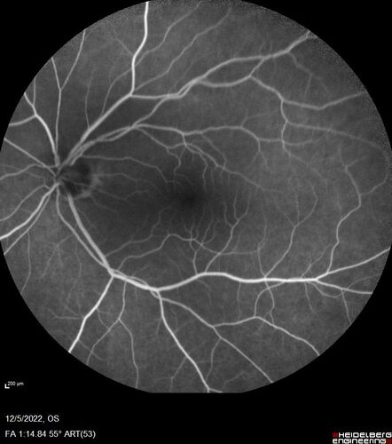 Macular schisis with no leakage on FA - Presumed Nerve pit maculopathy
73-year old female.  Had treatment trial with Eylea with no benefit (4 months).  Vision is 20/32 in left eye and has remained there (with a dense cataract).
