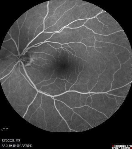 Macular schisis with no leakage on FA - Presumed Nerve pit maculopathy
73-year old female.  Had treatment trial with Eylea with no benefit (4 months).  Vision is 20/32 in left eye and has remained there (with a dense cataract).
