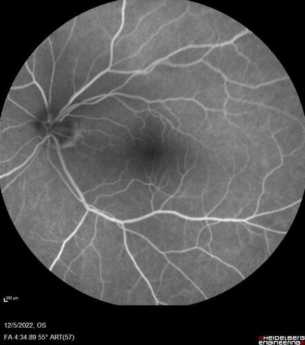 Macular schisis with no leakage on FA - Presumed Nerve pit maculopathy
73-year old female.  Had treatment trial with Eylea with no benefit (4 months).  Vision is 20/32 in left eye and has remained there (with a dense cataract).
