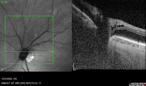 Macular schisis with no leakage on FA - Presumed Nerve pit maculopathy
73-year old female.  Had treatment trial with Eylea with no benefit (4 months).  Vision is 20/32 in left eye and has remained there (with a dense cataract).
