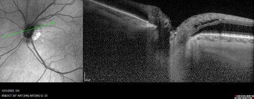Macular schisis with no leakage on FA - Presumed Nerve pit maculopathy
73-year old female.  Had treatment trial with Eylea with no benefit (4 months).  Vision is 20/32 in left eye and has remained there (with a dense cataract).

