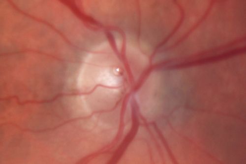 Post-Pneumatic Retinopexy Gas Bubble on Optic Nerve
80 year old man, 2 weeks post C3F8 pneumatic retinopexy for 5/200 macula-off retinal detachment.  Vision is 20/50 (final vision was about 20/30).  There is a gas bubble trapped in the optic nerve.
