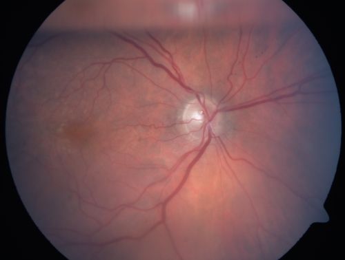 Post-Pneumatic Retinopexy Gas Bubble on Optic Nerve
80 year old man, 2 weeks post C3F8 pneumatic retinopexy for 5/200 macula-off retinal detachment.  Vision is 20/50 (final vision was about 20/30).  There is a gas bubble trapped in the optic nerve.
