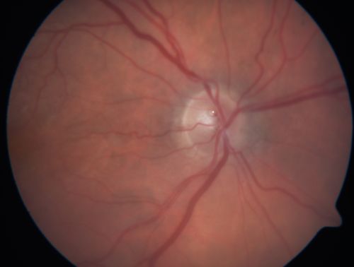 Post-Pneumatic Retinopexy Gas Bubble on Optic Nerve
80 year old man, 2 weeks post C3F8 pneumatic retinopexy for 5/200 macula-off retinal detachment.  Vision is 20/50 (final vision was about 20/30).  There is a gas bubble trapped in the optic nerve.
