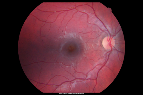 Optic Nerve Pit  Retinal Detachment - Macular Detachment - 8 Year Old - 5/200 Vision OS
8-year-old child on two school exams that his vision was poor in the left eye and his last normal exam was in preschool. 

VISUAL ACUITY:  OD 20/30,  OS 5/200.   OS: Vertical C/D ratio is 0.2.  There is a whitening on the temporal edge of the optic nerve consistent with an optic disc pit and there is a serous macular detachment.  

