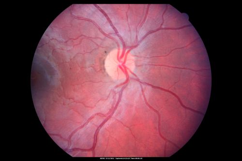 Optic Nerve Pit  Retinal Detachment - Macular Detachment - 8 Year Old - 5/200 Vision OS
8-year-old child on two school exams that his vision was poor in the left eye and his last normal exam was in preschool. 

VISUAL ACUITY:  OD 20/30,  OS 5/200.   OS: Vertical C/D ratio is 0.2.  There is a whitening on the temporal edge of the optic nerve consistent with an optic disc pit and there is a serous macular detachment.  

