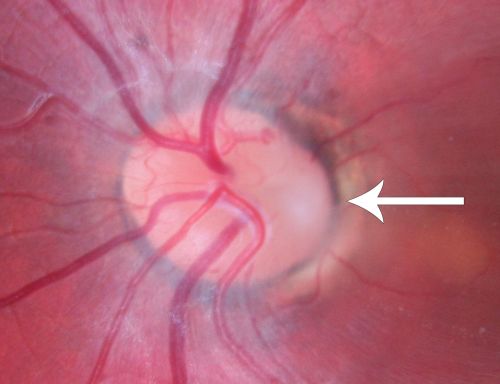Optic Nerve Pit  Retinal Detachment - Macular Detachment - 8 Year Old - 5/200 Vision OS
8-year-old child on two school exams that his vision was poor in the left eye and his last normal exam was in preschool. 

VISUAL ACUITY:  OD 20/30,  OS 5/200.   OS: Vertical C/D ratio is 0.2.  There is a whitening on the temporal edge of the optic nerve consistent with an optic disc pit and there is a serous macular detachment.  

