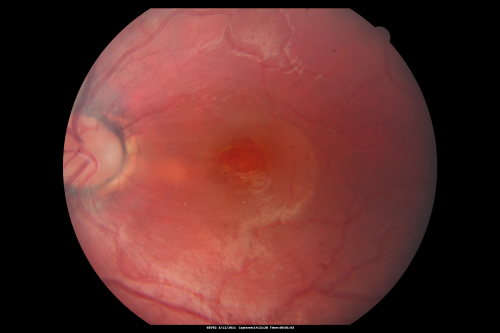 Optic Nerve Pit  Retinal Detachment - Macular Detachment - 8 Year Old - 5/200 Vision OS
8-year-old child on two school exams that his vision was poor in the left eye and his last normal exam was in preschool. 

VISUAL ACUITY:  OD 20/30,  OS 5/200.   OS: Vertical C/D ratio is 0.2.  There is a whitening on the temporal edge of the optic nerve consistent with an optic disc pit and there is a serous macular detachment.  

