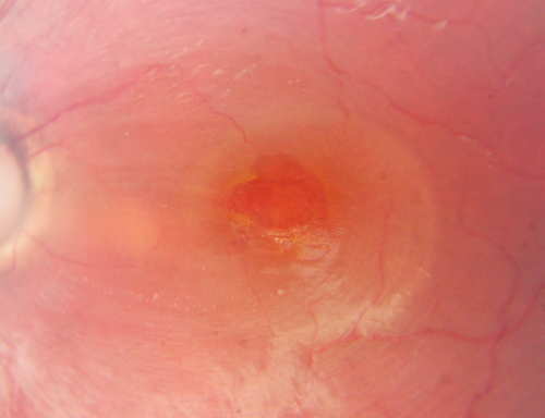 Optic Nerve Pit  Retinal Detachment - Macular Detachment - 8 Year Old - 5/200 Vision OS
8-year-old child on two school exams that his vision was poor in the left eye and his last normal exam was in preschool. 

VISUAL ACUITY:  OD 20/30,  OS 5/200.   OS: Vertical C/D ratio is 0.2.  There is a whitening on the temporal edge of the optic nerve consistent with an optic disc pit and there is a serous macular detachment.  

