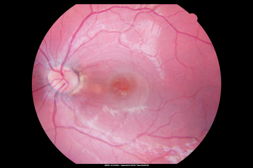 Optic Nerve Pit  Retinal Detachment - Macular Detachment - 8 Year Old - 5/200 Vision OS
8-year-old child on two school exams that his vision was poor in the left eye and his last normal exam was in preschool. 

VISUAL ACUITY:  OD 20/30,  OS 5/200.   OS: Vertical C/D ratio is 0.2.  There is a whitening on the temporal edge of the optic nerve consistent with an optic disc pit and there is a serous macular detachment.  

